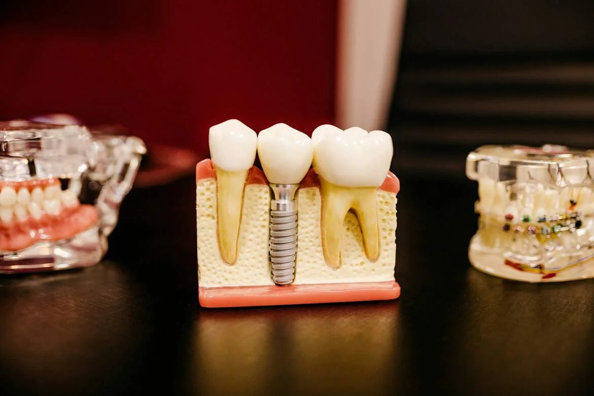 Full Arch Dental Implants — illustrative image