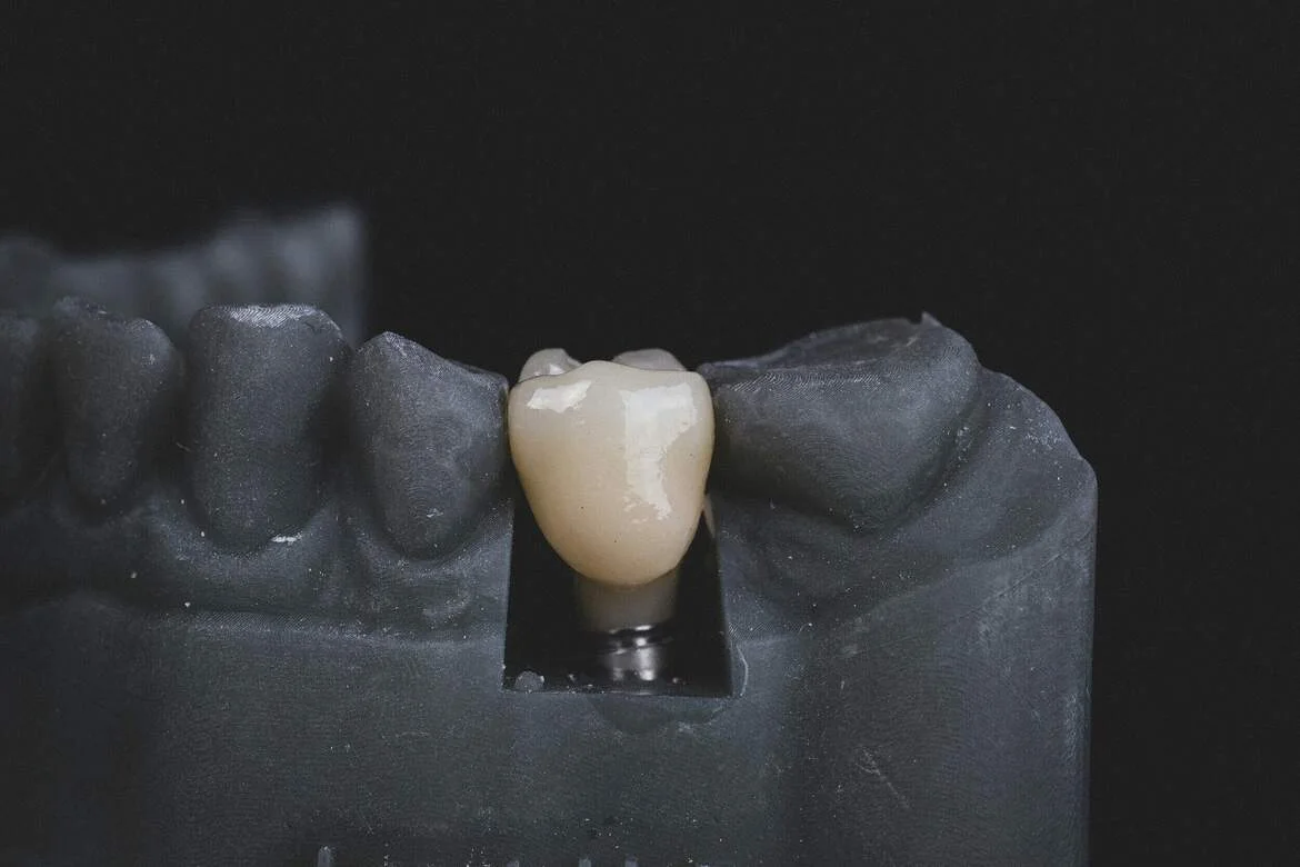 Single Tooth Dental Implants — illustrative image