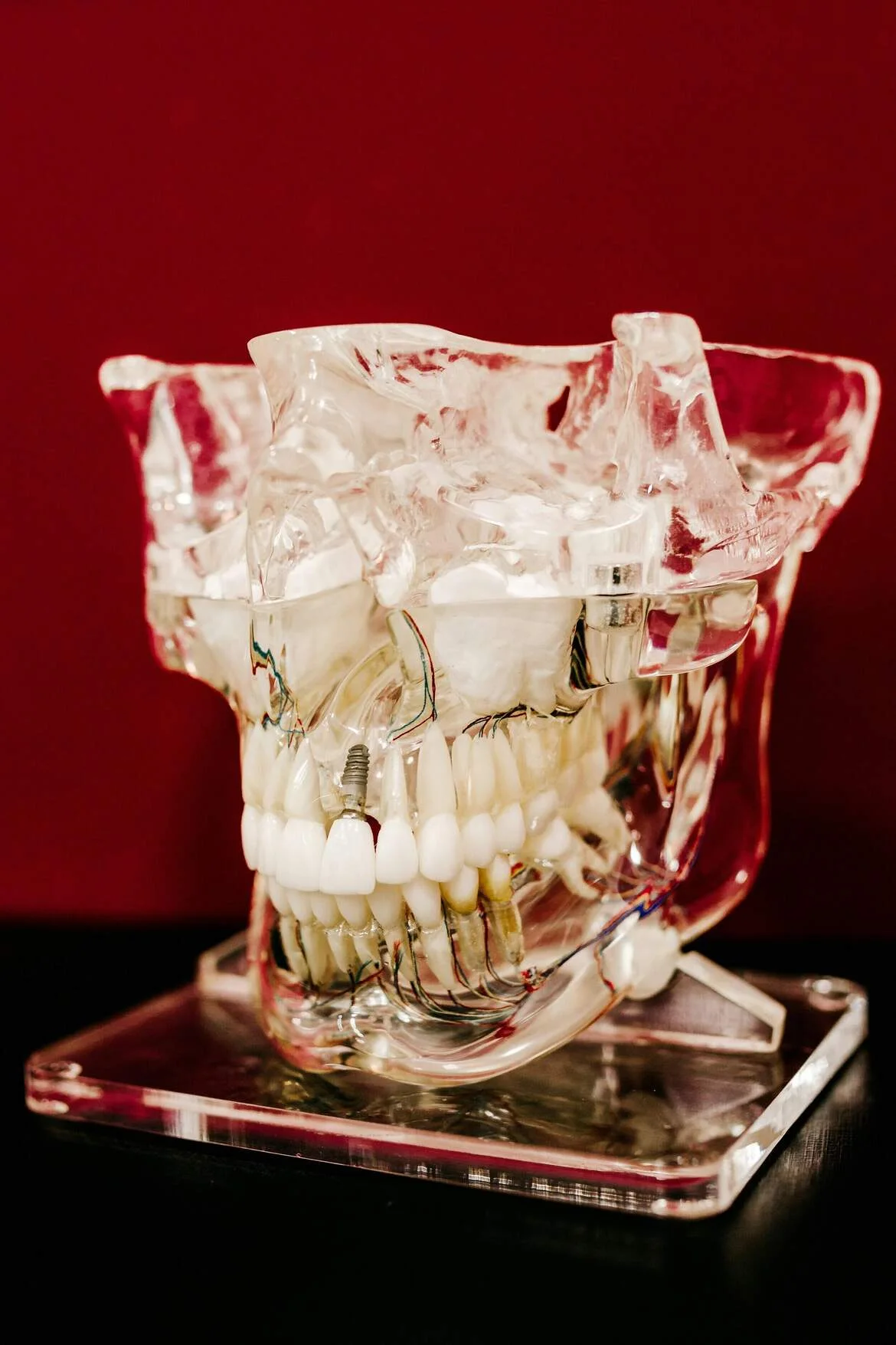 What Are Dental Implants? — illustrative image